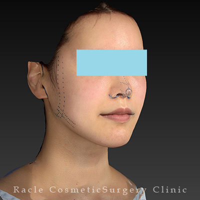 手術前デザイン