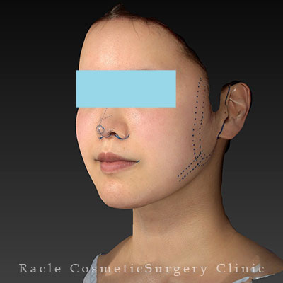 手術前デザイン