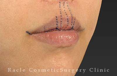 手術前デザイン