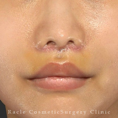 手術後１週間目