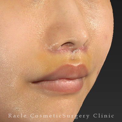 手術後１週間目