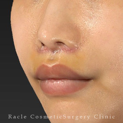 手術後１週間目