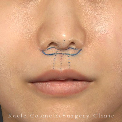 手術前デザイン