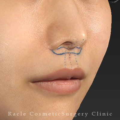 手術前デザイン