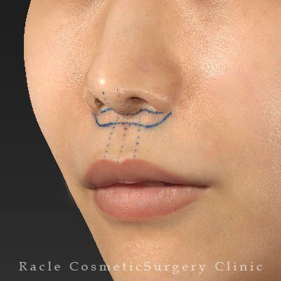 手術前デザイン