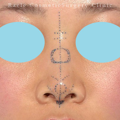 手術前デザイン