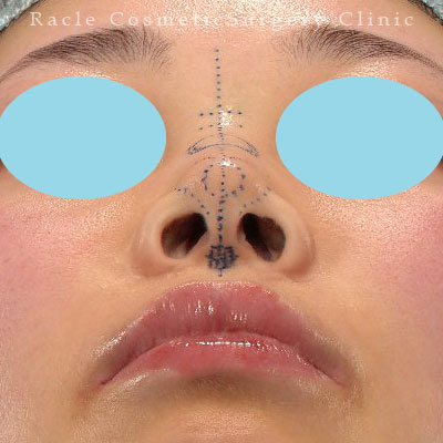 手術前デザイン