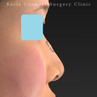 手術前デザイン