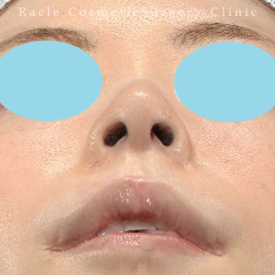 手術後12ヶ月目