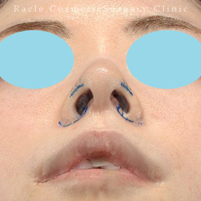 手術前デザイン