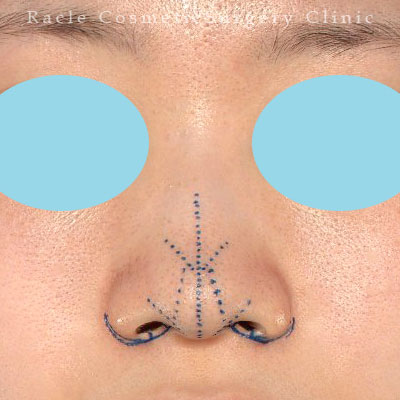 手術前デザイン