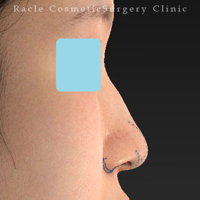 手術前デザイン