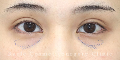 手術前デザイン