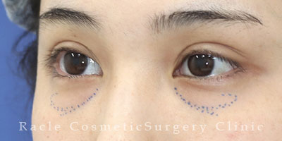 手術前デザイン