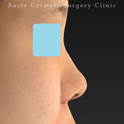 手術前デザイン