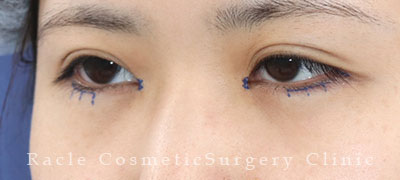 手術前デザイン