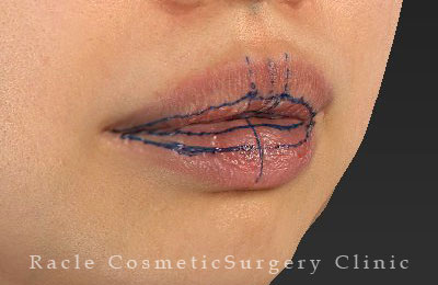 手術前デザイン