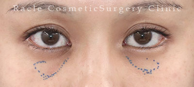 手術前デザイン