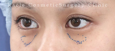 手術前デザイン