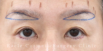 手術前デザイン