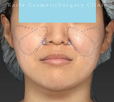 手術前デザイン