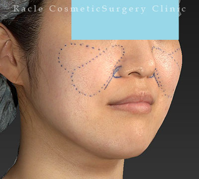 手術前デザイン