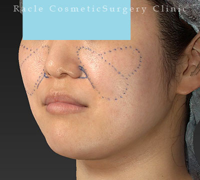 手術前デザイン