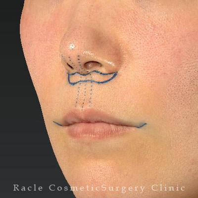 手術前デザイン