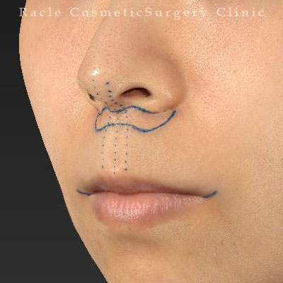 手術前デザイン