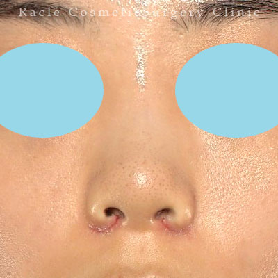 手術後１週間目