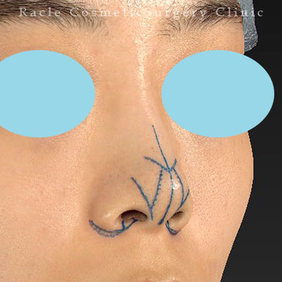 手術前デザイン