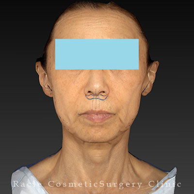 手術前デザイン