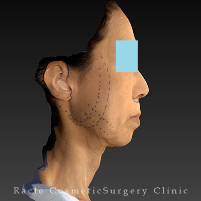 手術前デザイン