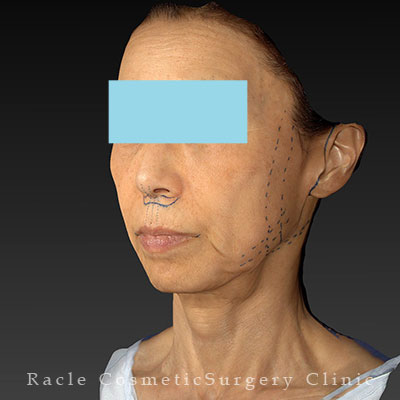 手術前デザイン