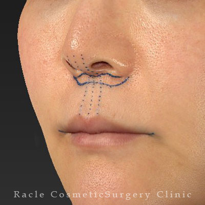 手術前デザイン