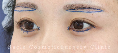 手術前デザイン