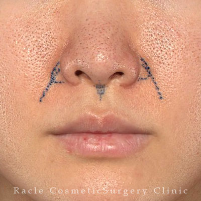 手術前デザイン