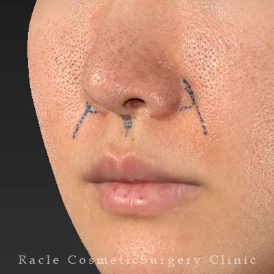 手術前デザイン