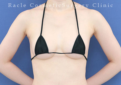 手術後12ヶ月目