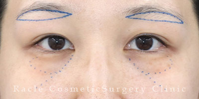 手術前デザイン