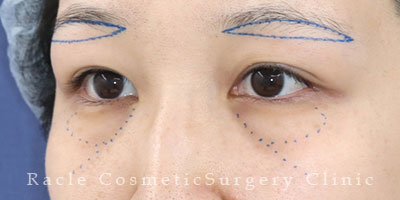 手術前デザイン