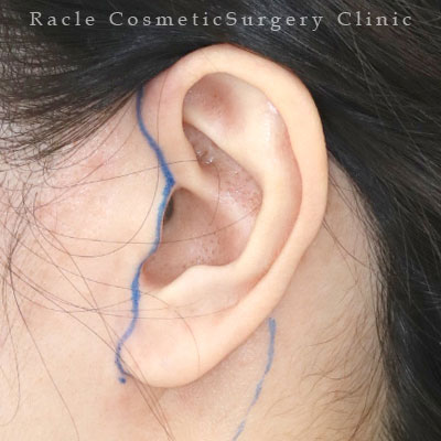 手術前デザイン