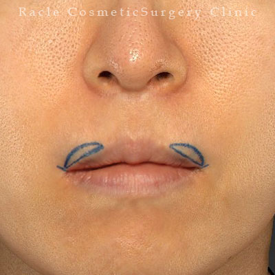 手術前デザイン