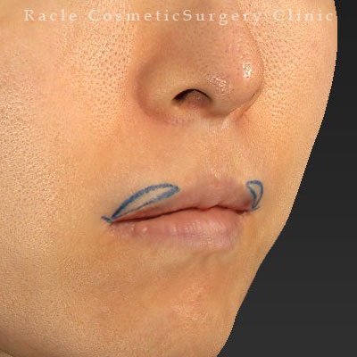 手術前デザイン