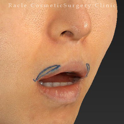 手術前デザイン