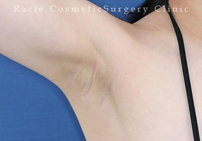 手術後12ヶ月目