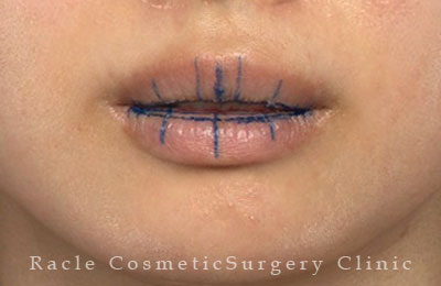 手術前デザイン