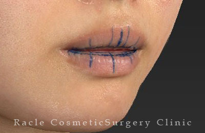 手術前デザイン