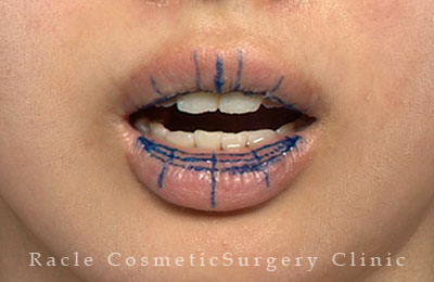 手術前デザイン