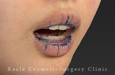 手術前デザイン